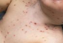 Saúde está em alerta máximo por aumento do sarampo nas Américas