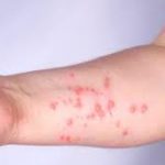 Vigilância Epidemiológica de Cachoeira orienta sobre casos e sintomas da Mpox Vigilância Epidemiológica de Cachoeira orienta sobre casos e sintomas da Mpox