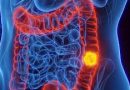 SUS adota novo exame para detectar câncer de intestino antes dos sintomas