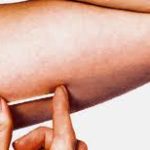 Saúde inicia capacitação de profissionais para implantação do contraceptivo Implanon na rede pública